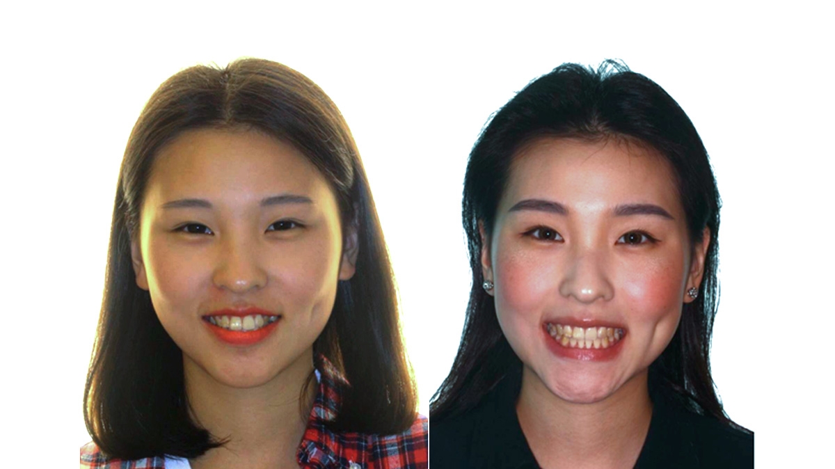 混亂擁擠牙齒矯正對照圖