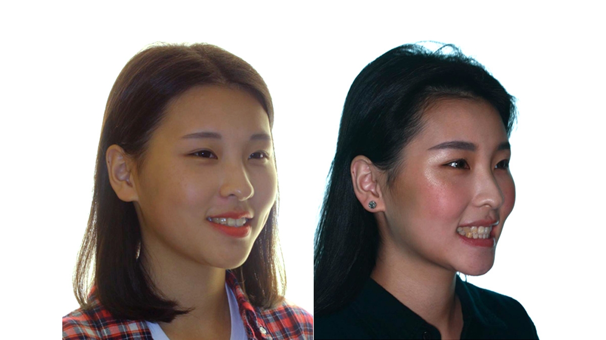 混亂擁擠牙齒矯正對照圖二