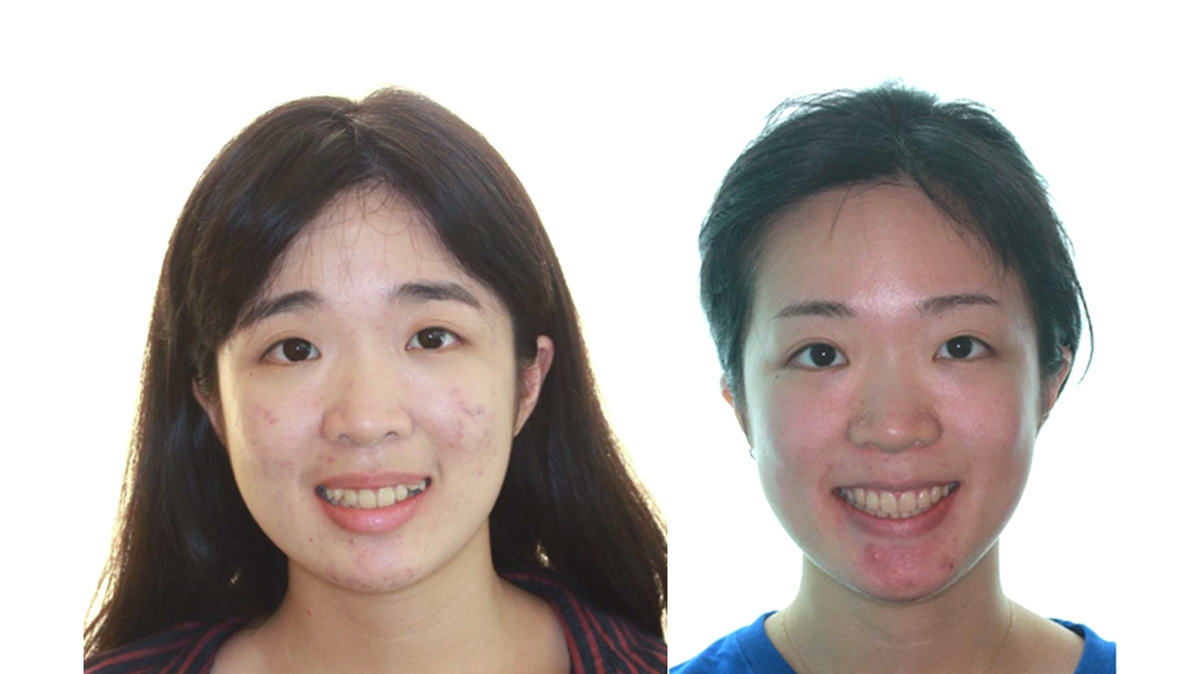 混亂擁擠牙齒矯正對照圖