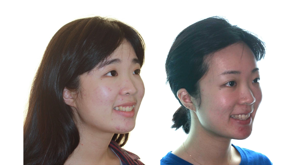 混亂擁擠牙齒矯正對照圖二