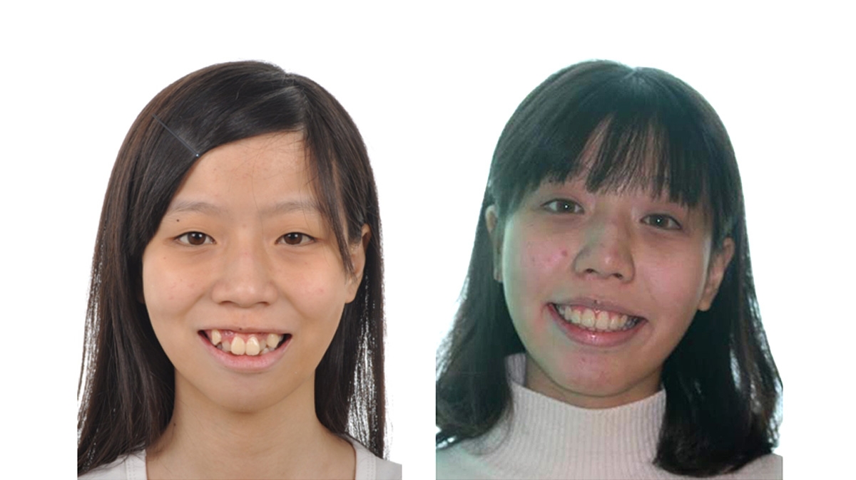 混亂擁擠牙齒矯正對照圖