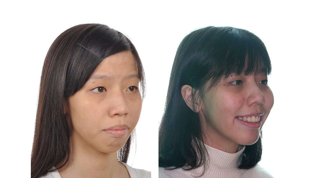 混亂擁擠牙齒矯正對照圖二