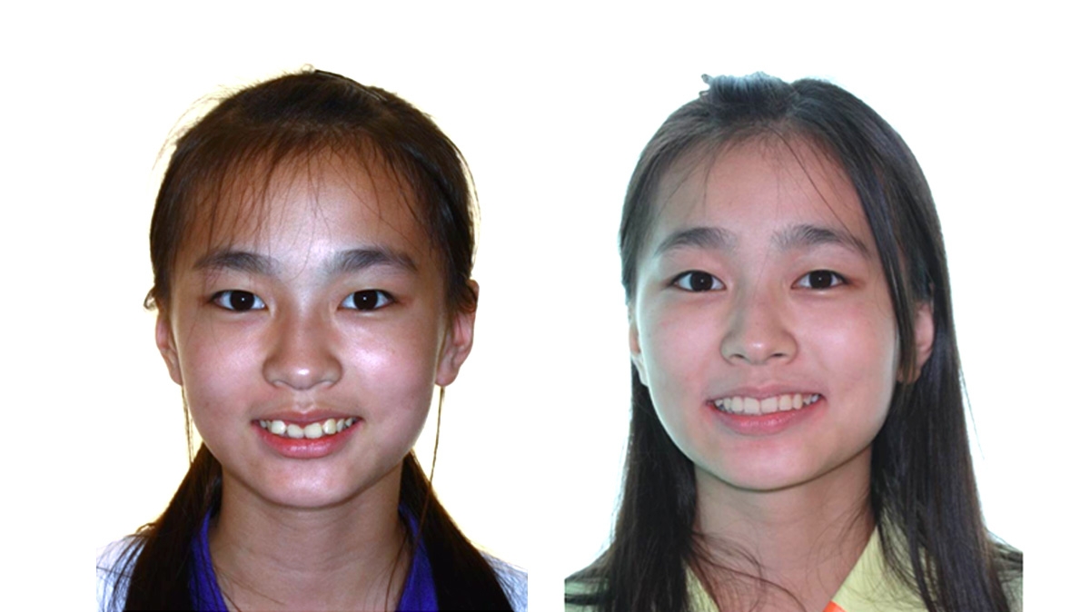 混亂擁擠牙齒矯正對照圖