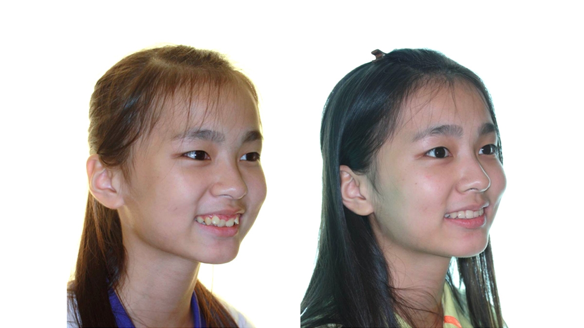 混亂擁擠牙齒矯正對照圖二