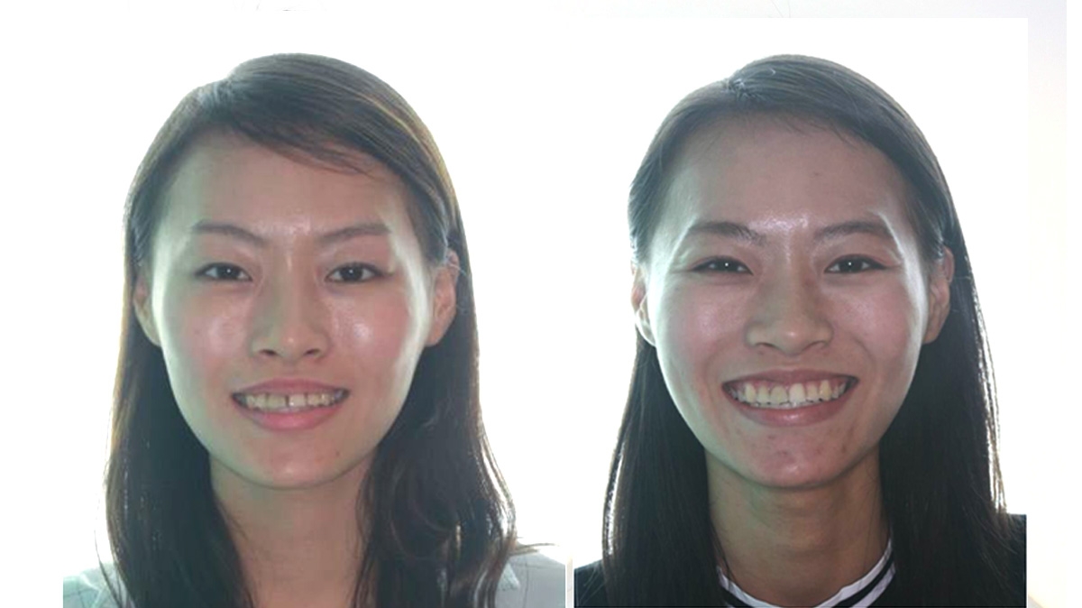 漏風牙齒矯正對照圖