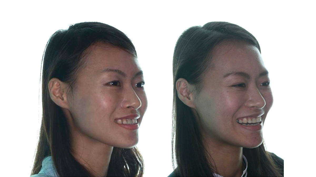 漏風牙齒矯正對照圖二