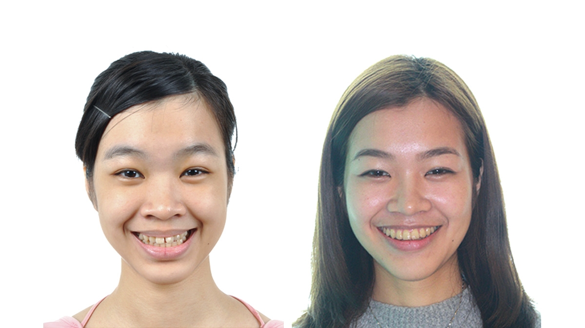 漏風牙齒矯正對照圖