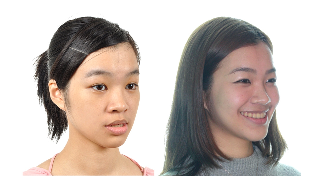 漏風牙齒矯正對照圖二