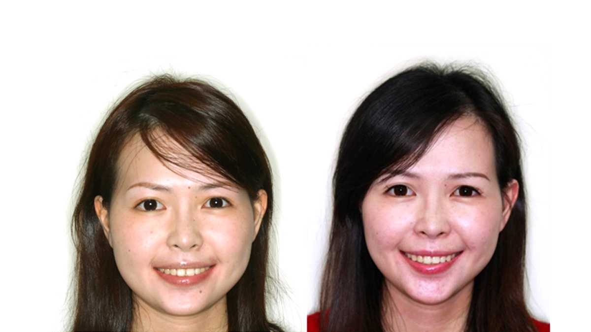 漏風牙齒矯正對照圖