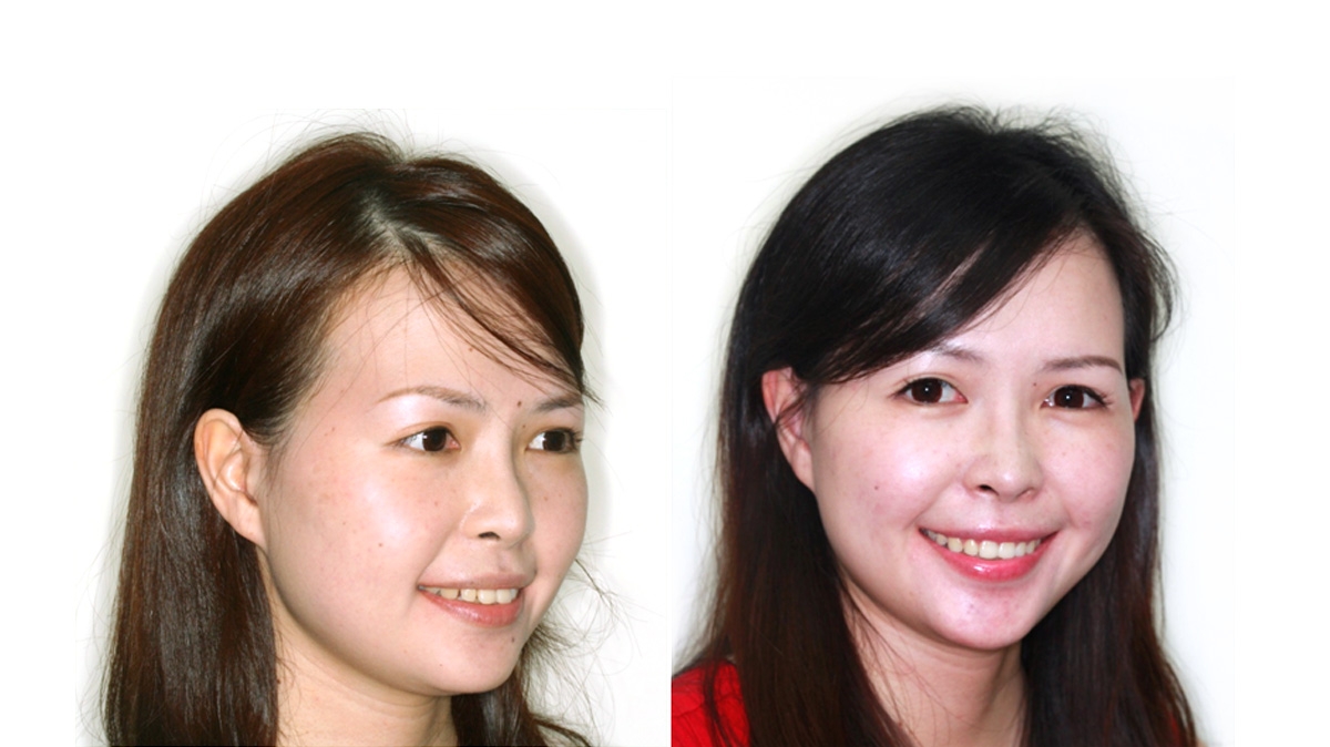 漏風牙齒矯正對照圖二